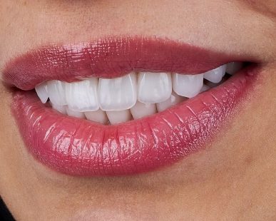 krzywe zęby a bonding