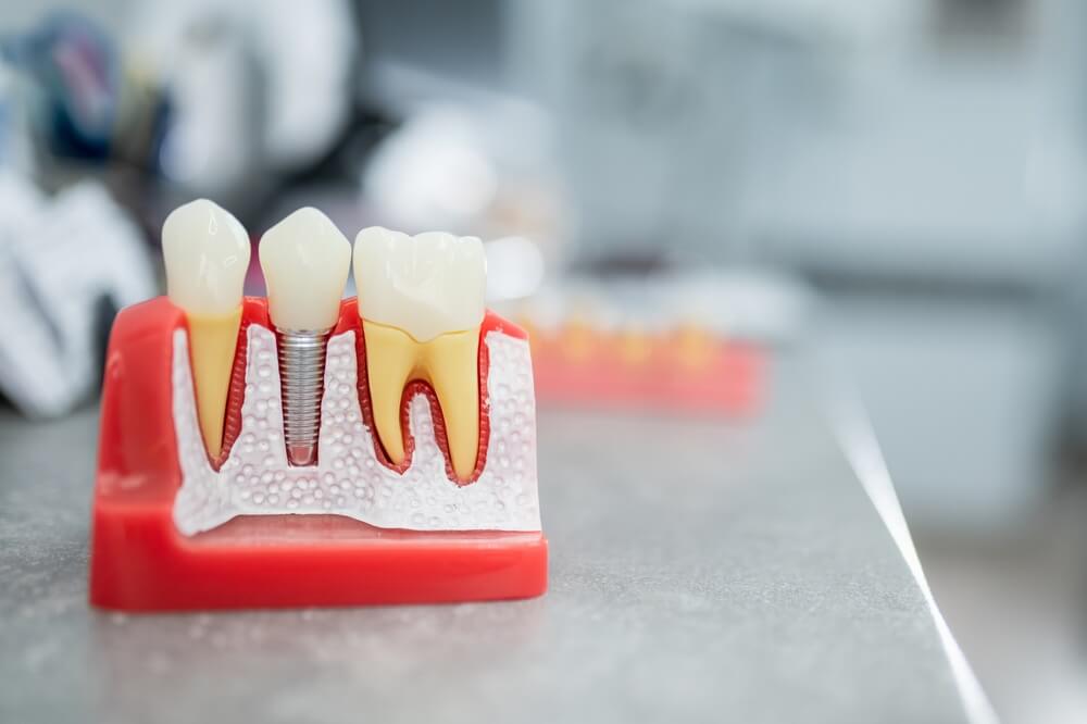 wszczepienie implantu